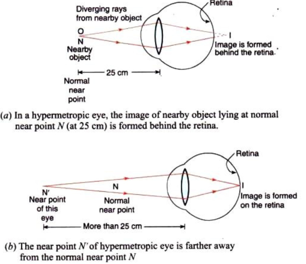 Defects Of Vision And Their Correction - Class 10, The Human Eyes And ...