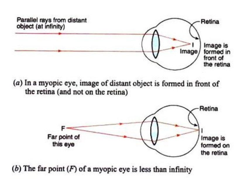 myopia ray diagram)