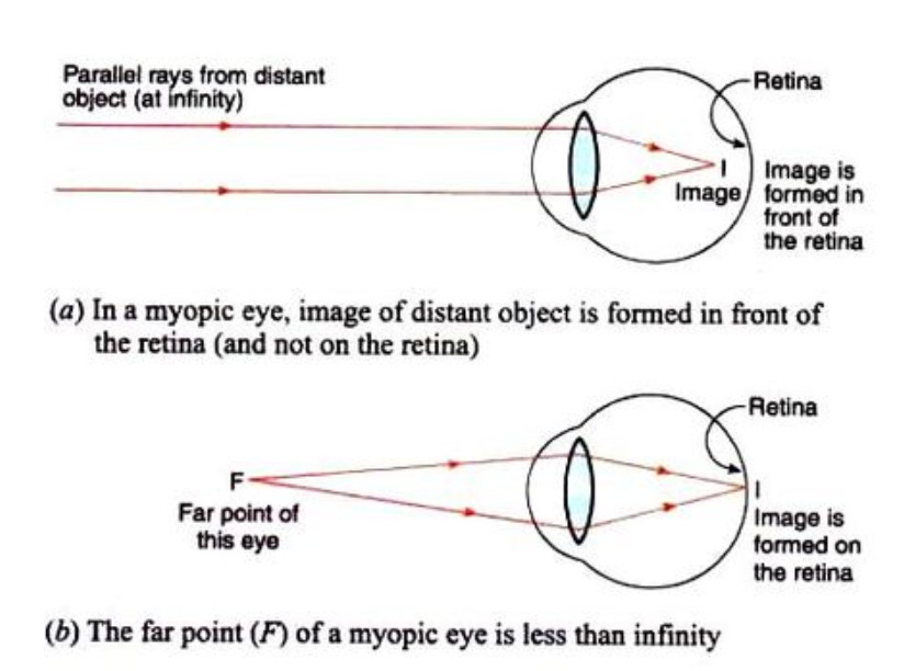 myopia diagram class 10