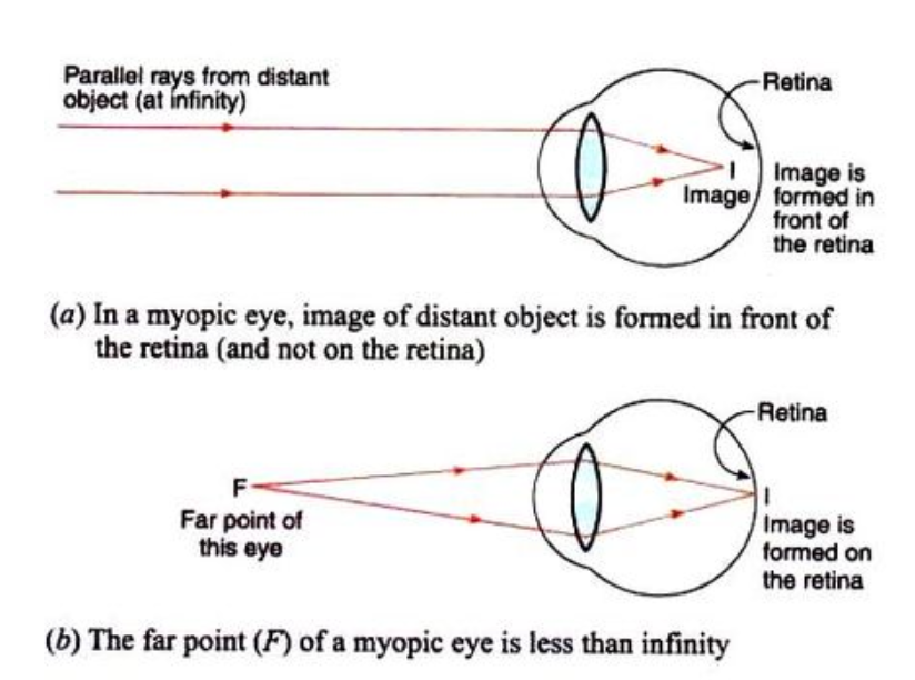 Myopia Power Chart